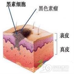 颅内黑色素瘤