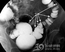 老年人结肠憩室