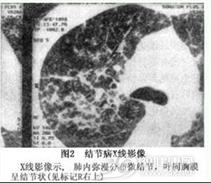 老年人结节病
