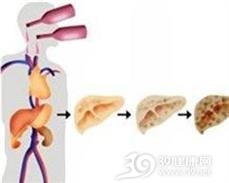 老年人酒精性肝病