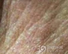老年性皮肤萎缩