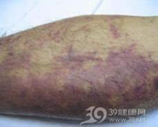 链球菌感染