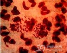 淋球菌性腹膜炎