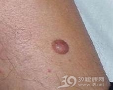 隆突性皮肤纤维肉瘤