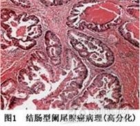 阑尾腺癌