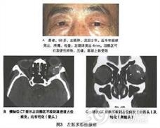 泪腺多形性腺癌