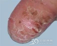 连续性肢端皮炎
