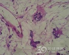 良性脂肪母细胞瘤