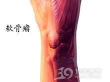 Maffucci综合征
