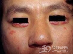 面部播散性粟粒状狼疮