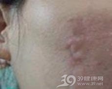 面部脓皮病