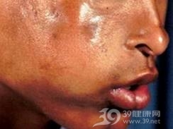 面部偏侧萎缩