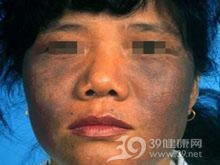 摩擦黑变病