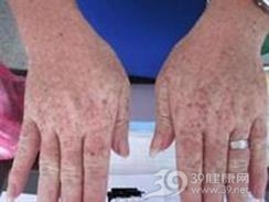 木村网状肢端色素沉着