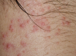梅毒合并HIV感染
