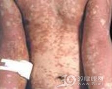 毛发红糠疹