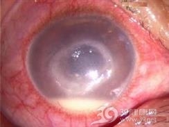 麻风性葡萄膜炎