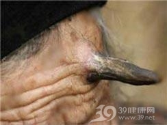 毛根鞘癌