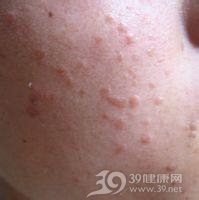 母瘊子