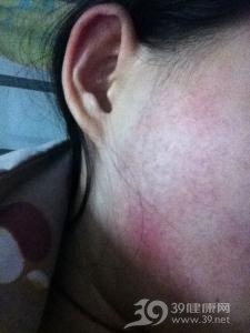 面颈部毛囊性红斑黑变病