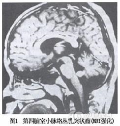 脉络丛乳头状瘤