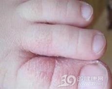糜烂型脚气