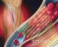 弥漫性食管壁内憩室