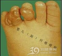 弥漫性婴儿纤维瘤病