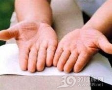 弥漫性掌跖角化病