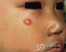 毛母质瘤