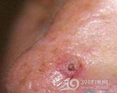 毛鞘棘皮瘤