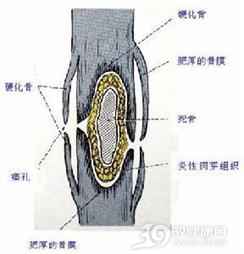 慢性化脓性骨髓炎