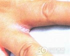 慢性黏膜皮肤念珠菌病