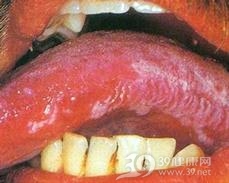 毛状白斑