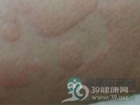 麻疹样红斑