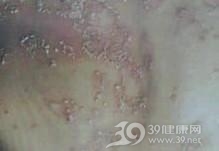 脓包型银屑病