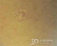 牛痘