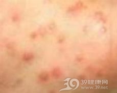 牛痘样水疱病