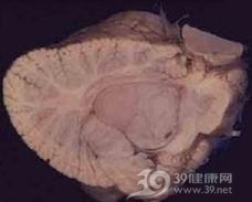 脑膜肉瘤