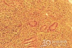 黏膜相关样组织淋巴瘤