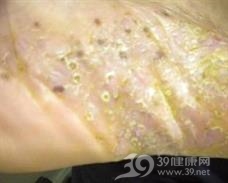 脓疱性细菌疹
