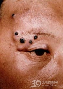 黏液性小汗腺癌
