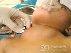囊状淋巴管瘤