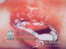 念珠状红苔藓