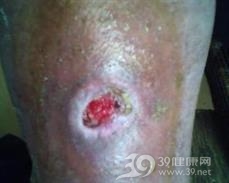 皮肤阿米巴病