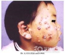 皮肤卟啉病