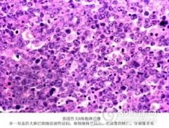 皮肤B细胞淋巴样结节型增生