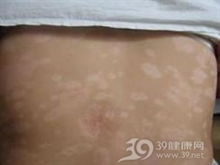 皮肤发育不良