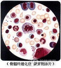 皮肤骨髓纤维化