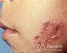 皮肤淋巴肉芽肿病